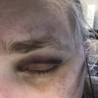Fall damage -- black eye a partial view of a face -- a closed left eye with prominent bruising